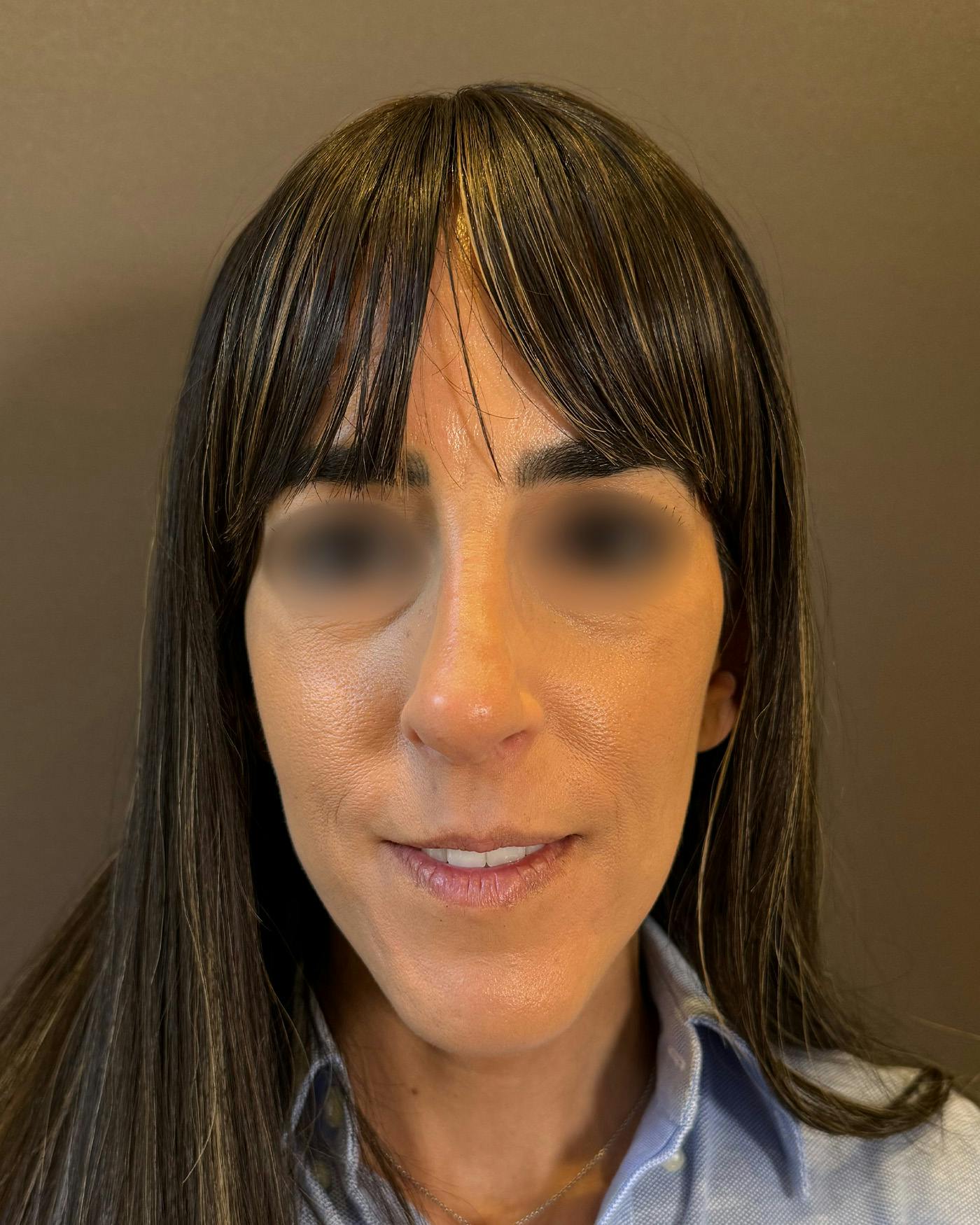Rhinoplasty Before & After Gallery - Patient 272636 - Image 6