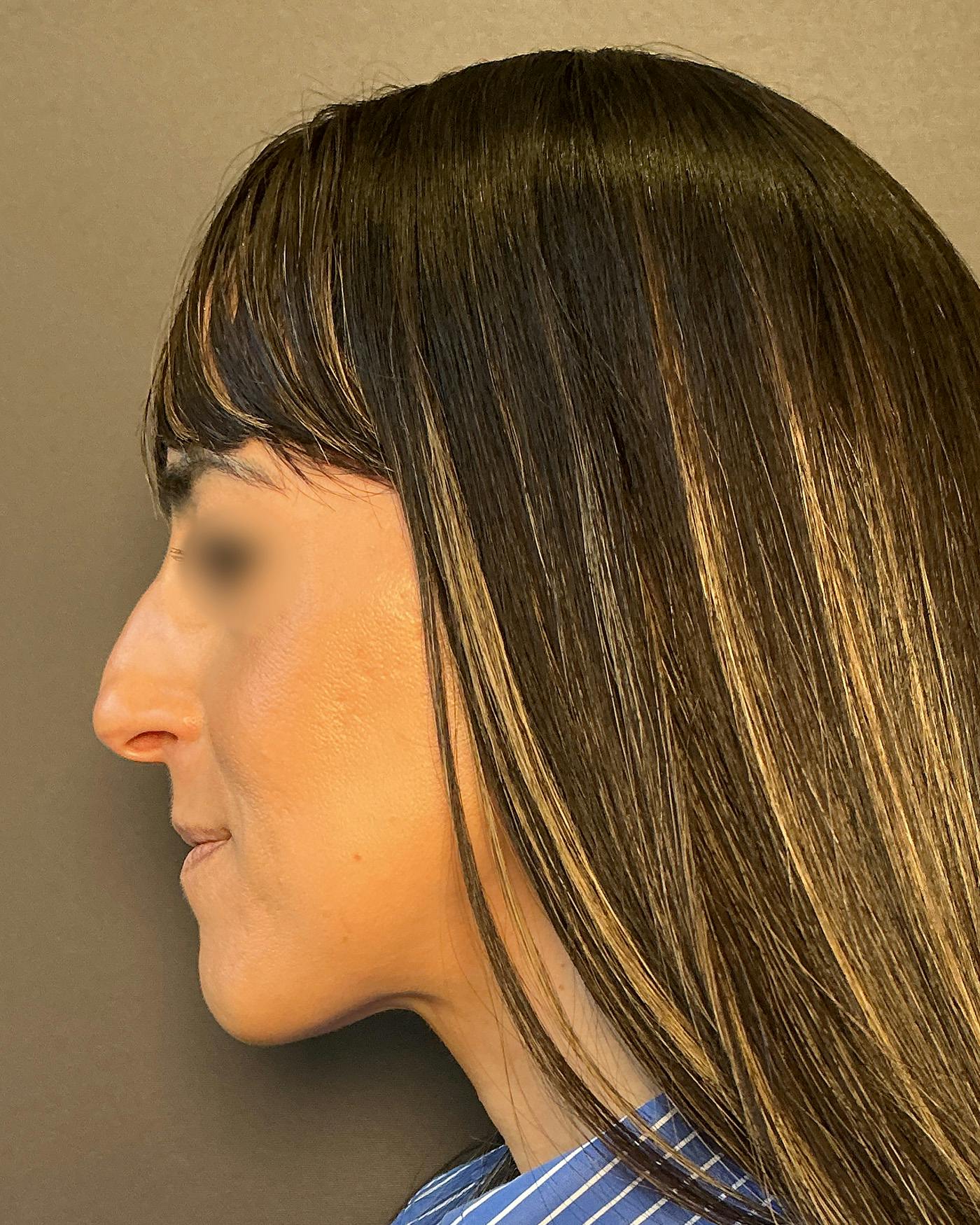 Rhinoplasty Before & After Gallery - Patient 272636 - Image 7