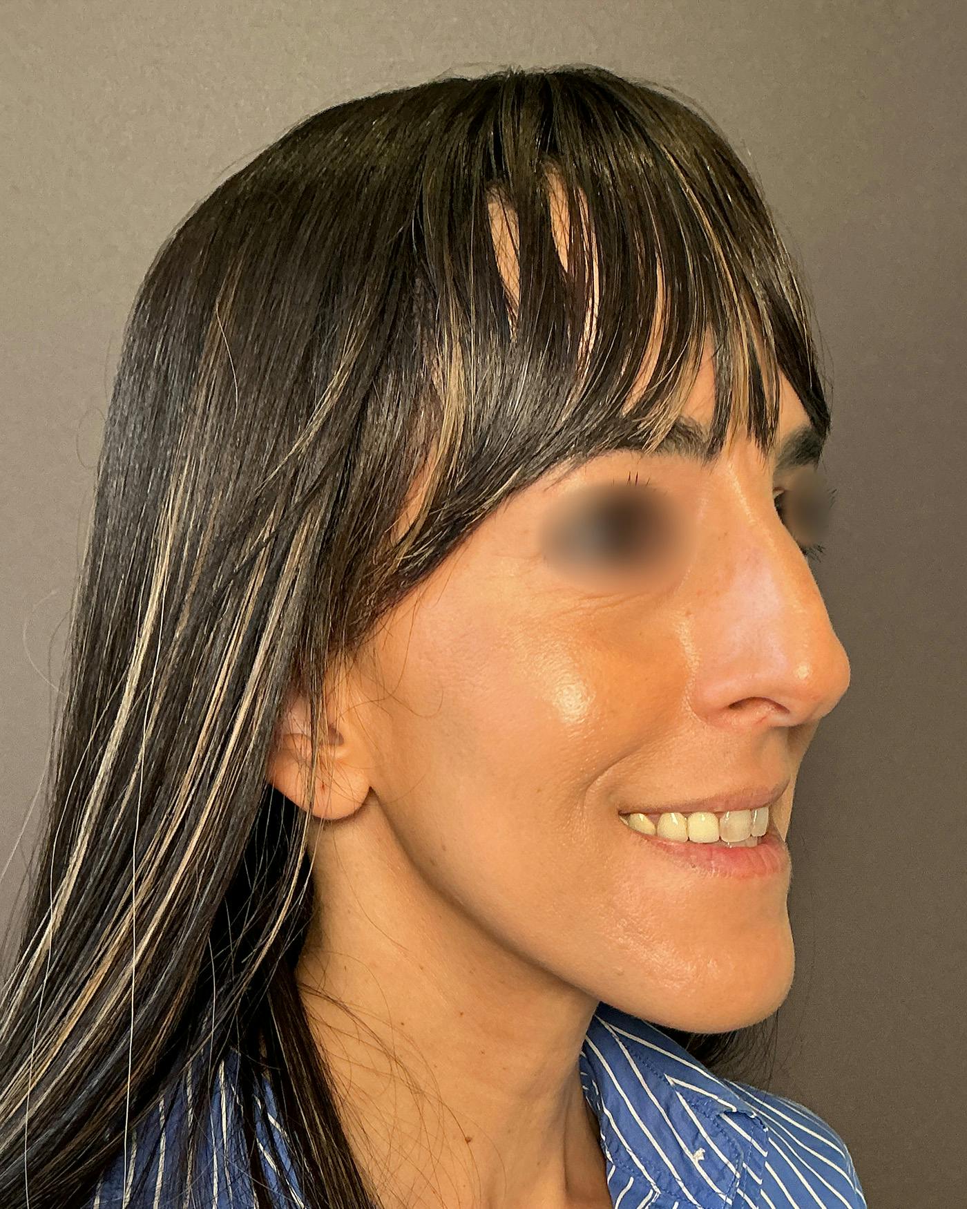 Rhinoplasty Before & After Gallery - Patient 272636 - Image 3