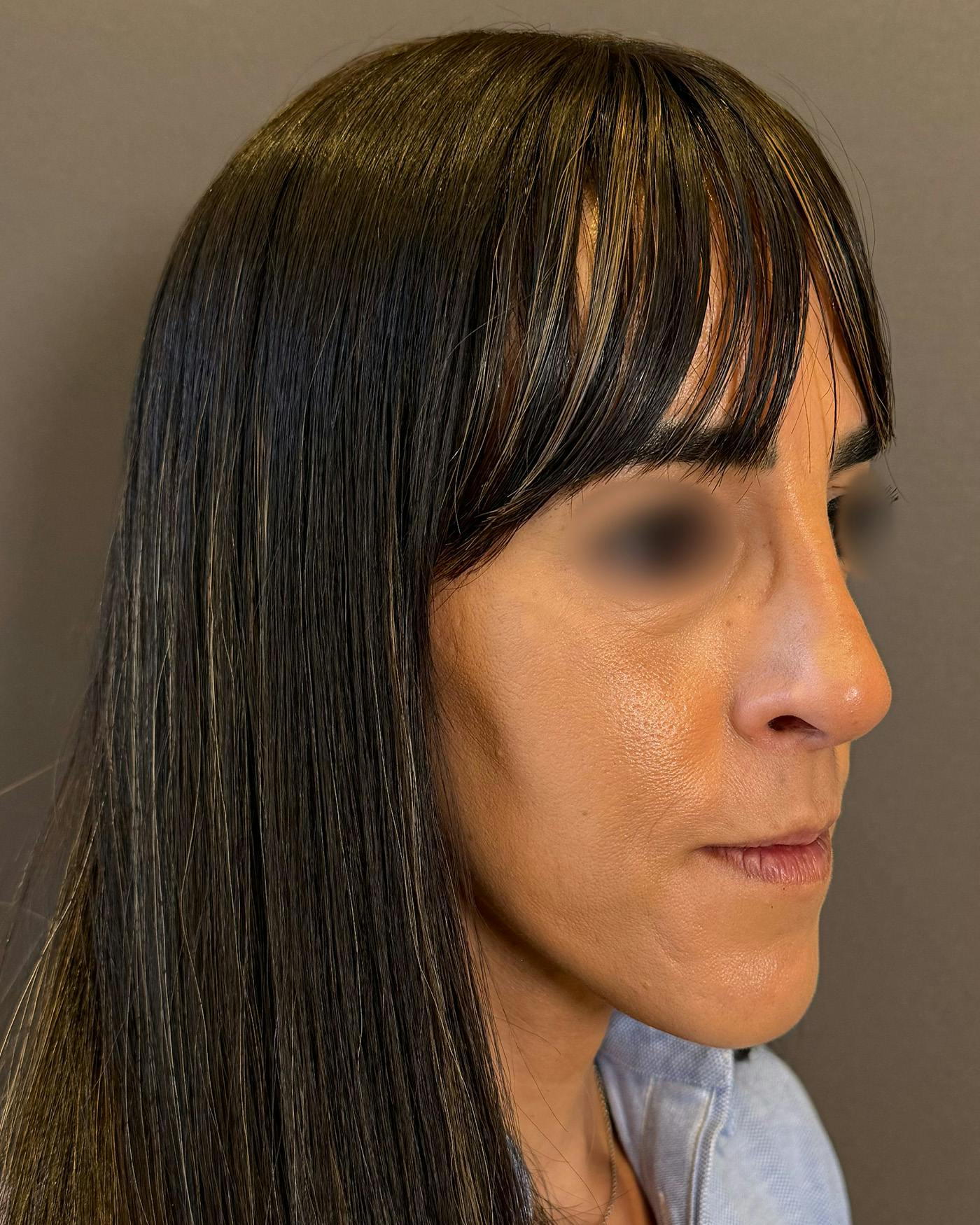 Rhinoplasty Before & After Gallery - Patient 272636 - Image 4