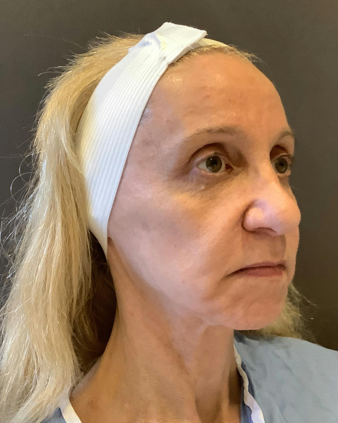 Facelifts / Necklift Before & After Gallery - Patient 506655 - Image 1