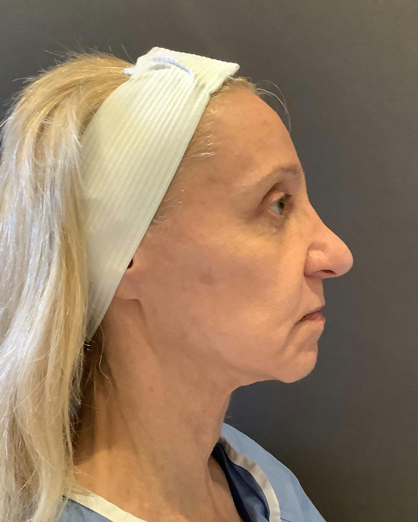 Facelifts / Necklift Before & After Gallery - Patient 506655 - Image 3