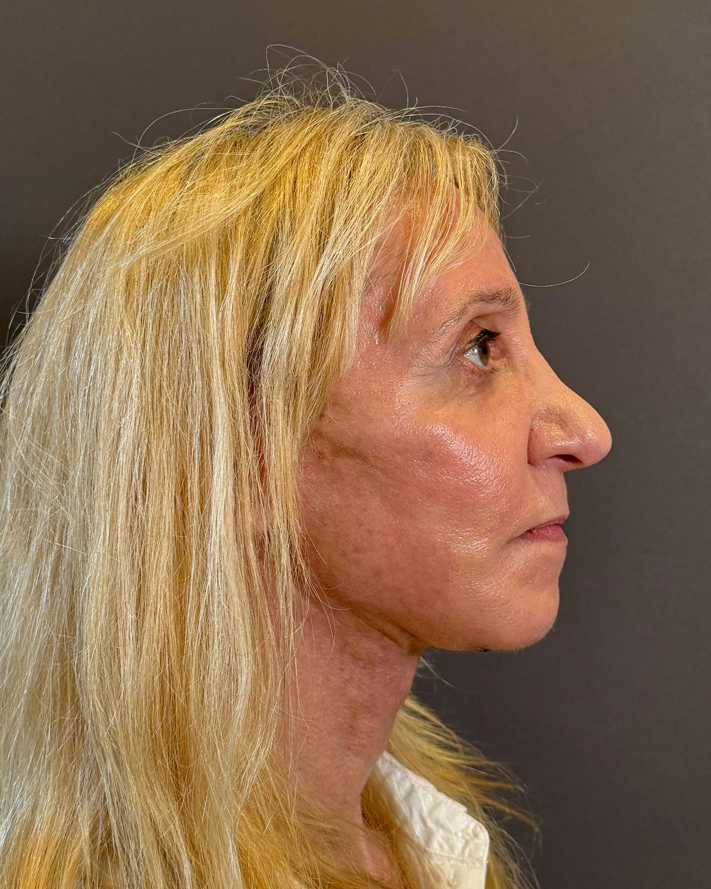Facelifts / Necklift Before & After Gallery - Patient 506655 - Image 4