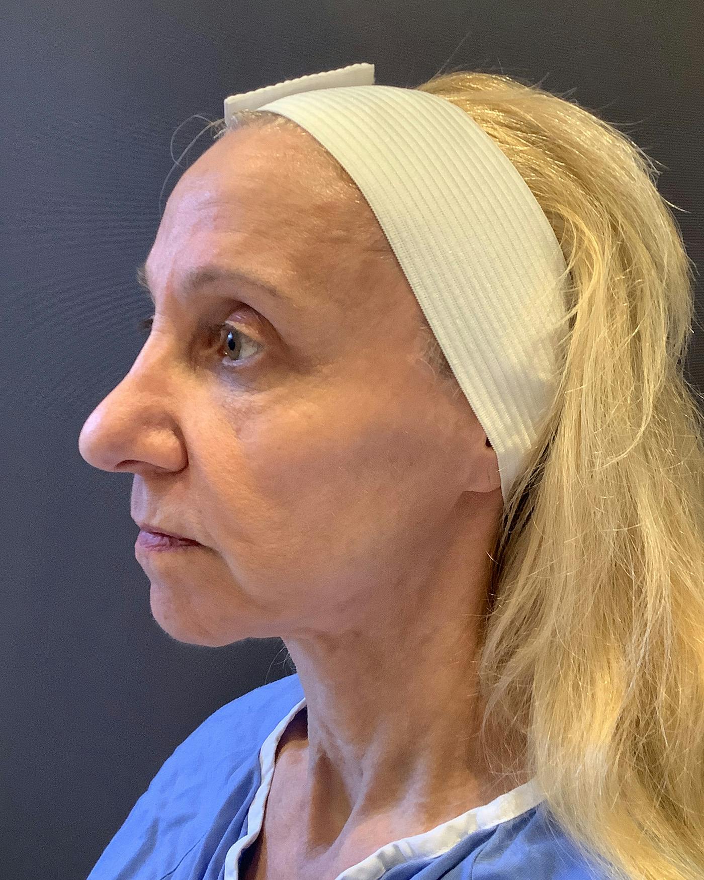 Facelifts / Necklift Before & After Gallery - Patient 506655 - Image 5