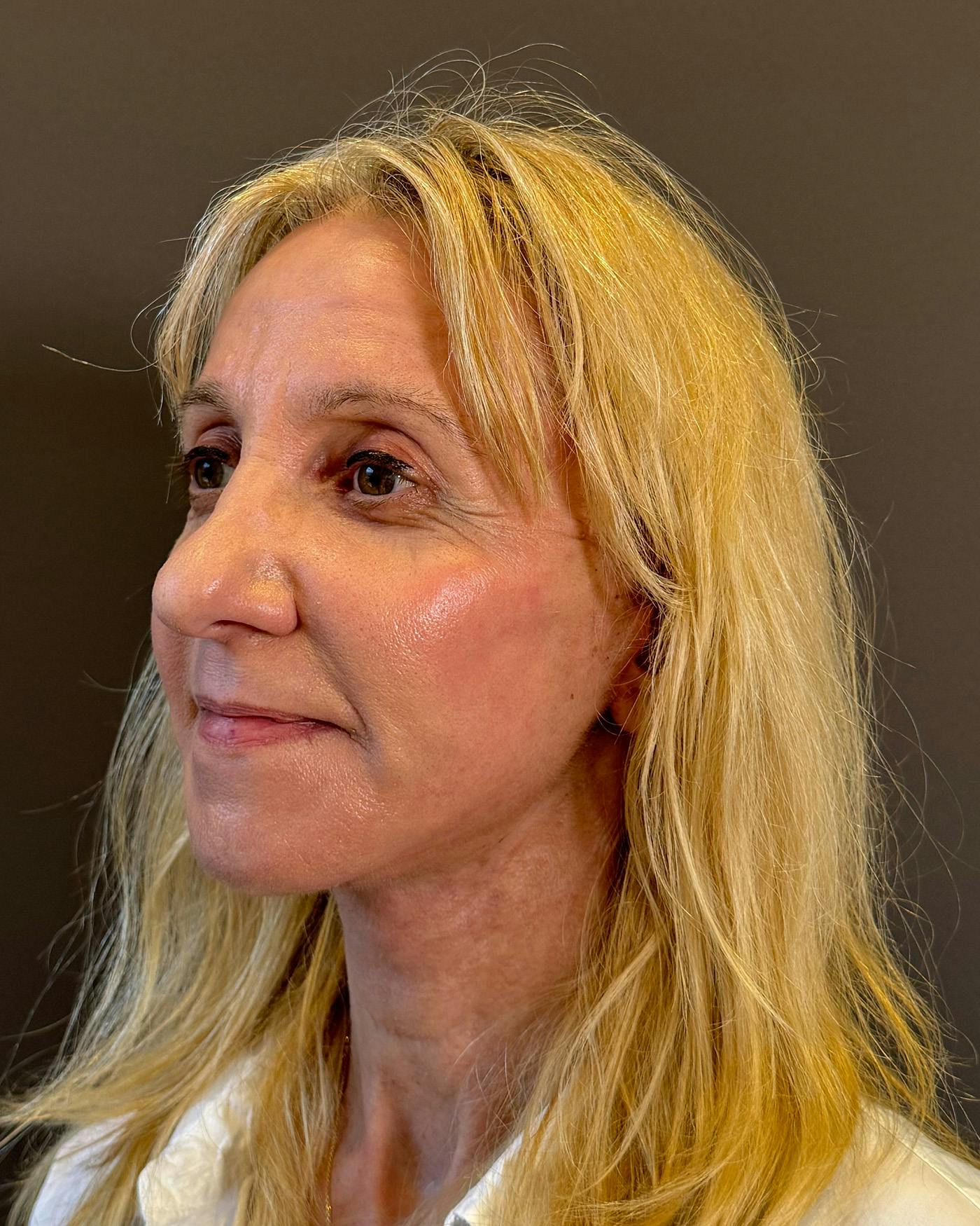 Facelifts / Necklift Before & After Gallery - Patient 506655 - Image 6