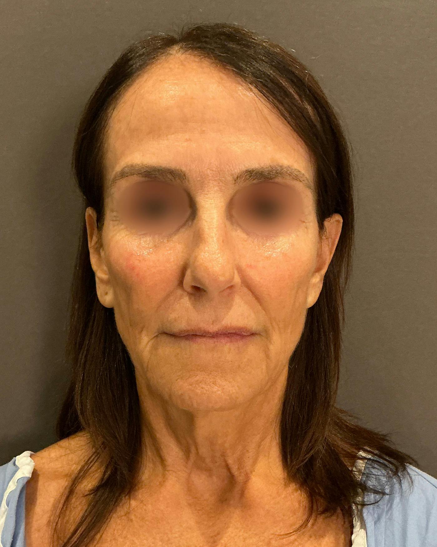 Facelifts / Necklift Before & After Gallery - Patient 780352 - Image 5