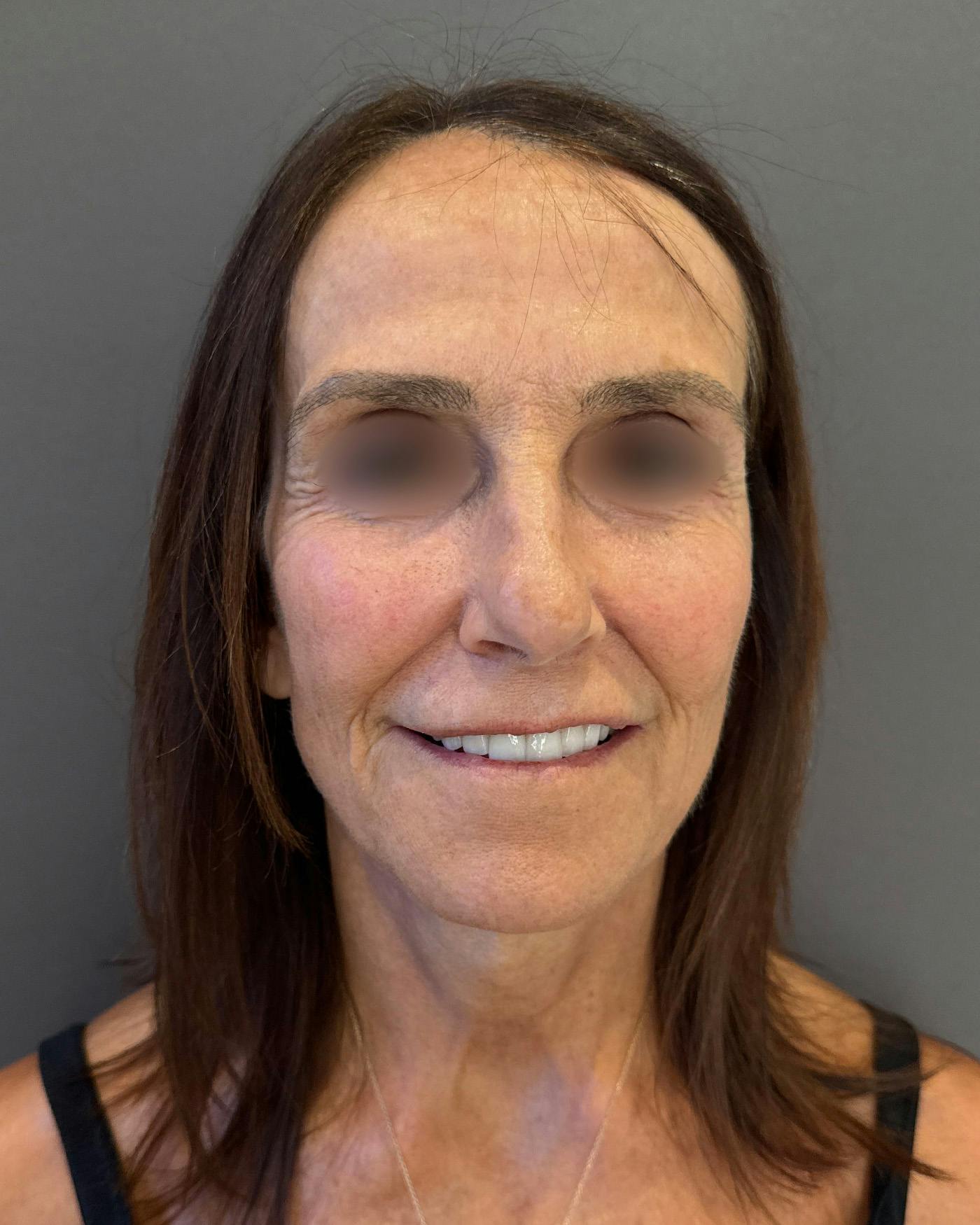 Facelifts / Necklift Before & After Gallery - Patient 780352 - Image 6