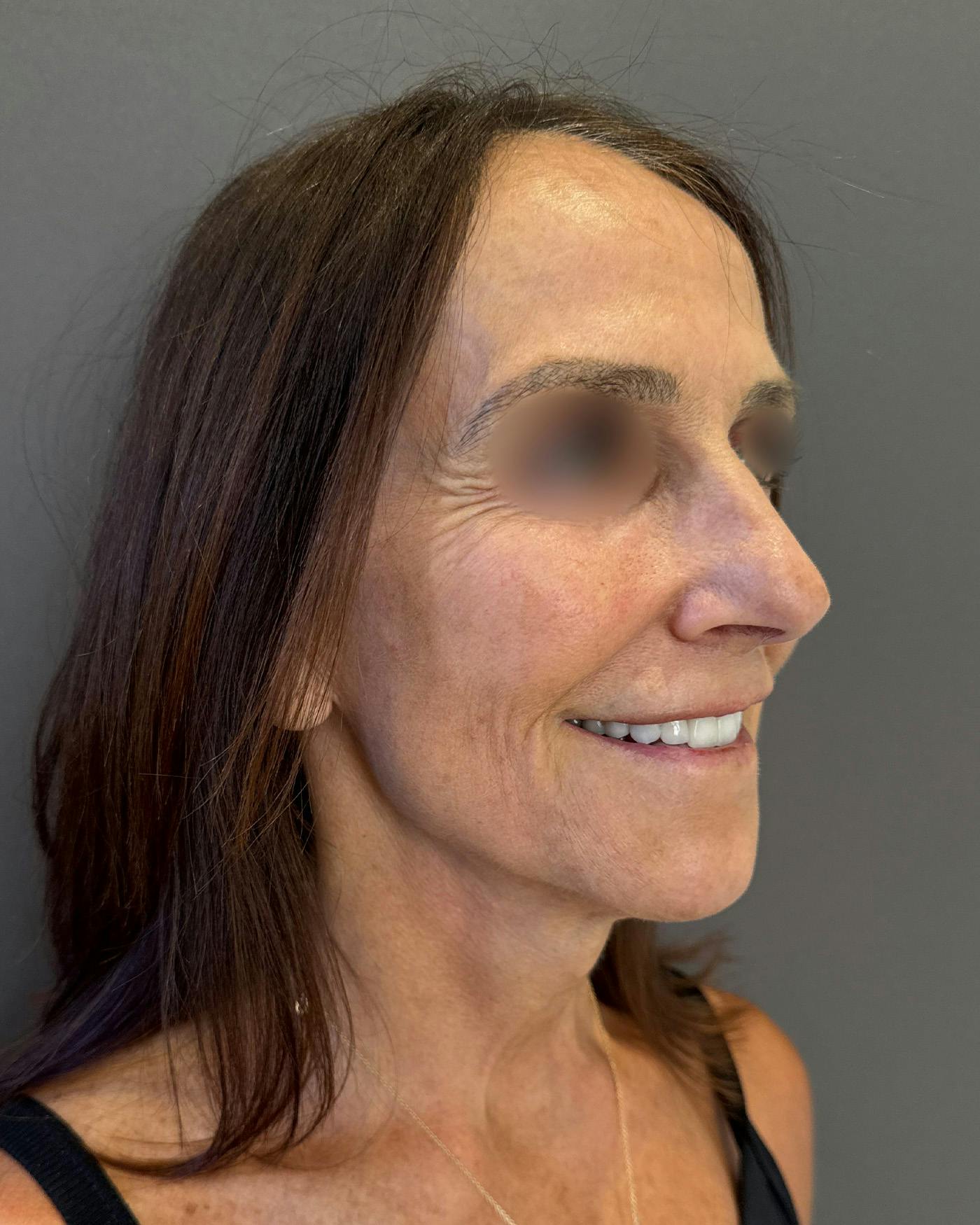 Facelifts / Necklift Before & After Gallery - Patient 780352 - Image 2
