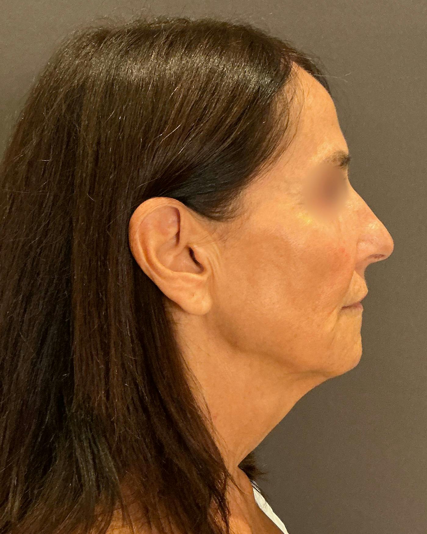 Facelifts / Necklift Before & After Gallery - Patient 780352 - Image 3