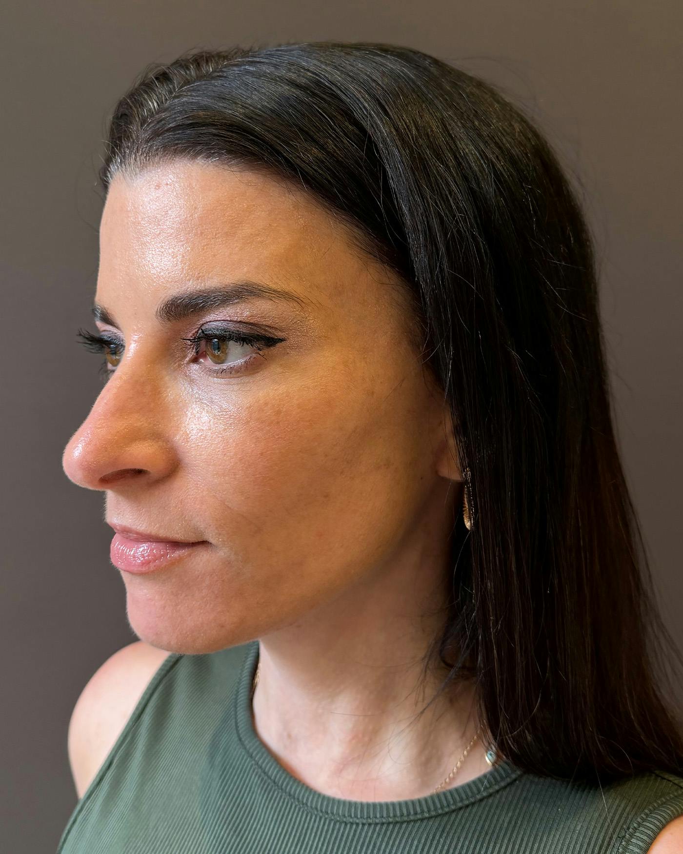 Facelifts / Necklift Before & After Gallery - Patient 371263 - Image 8
