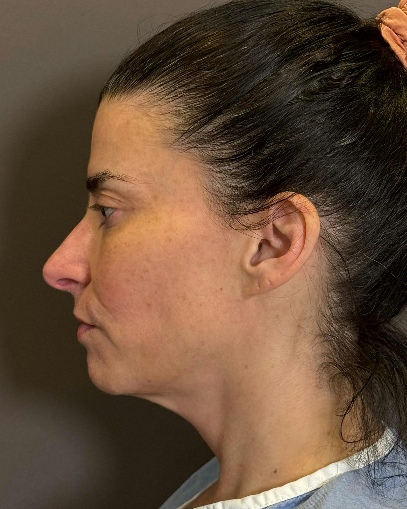 Facelifts / Necklift Before & After Gallery - Patient 371263 - Image 9