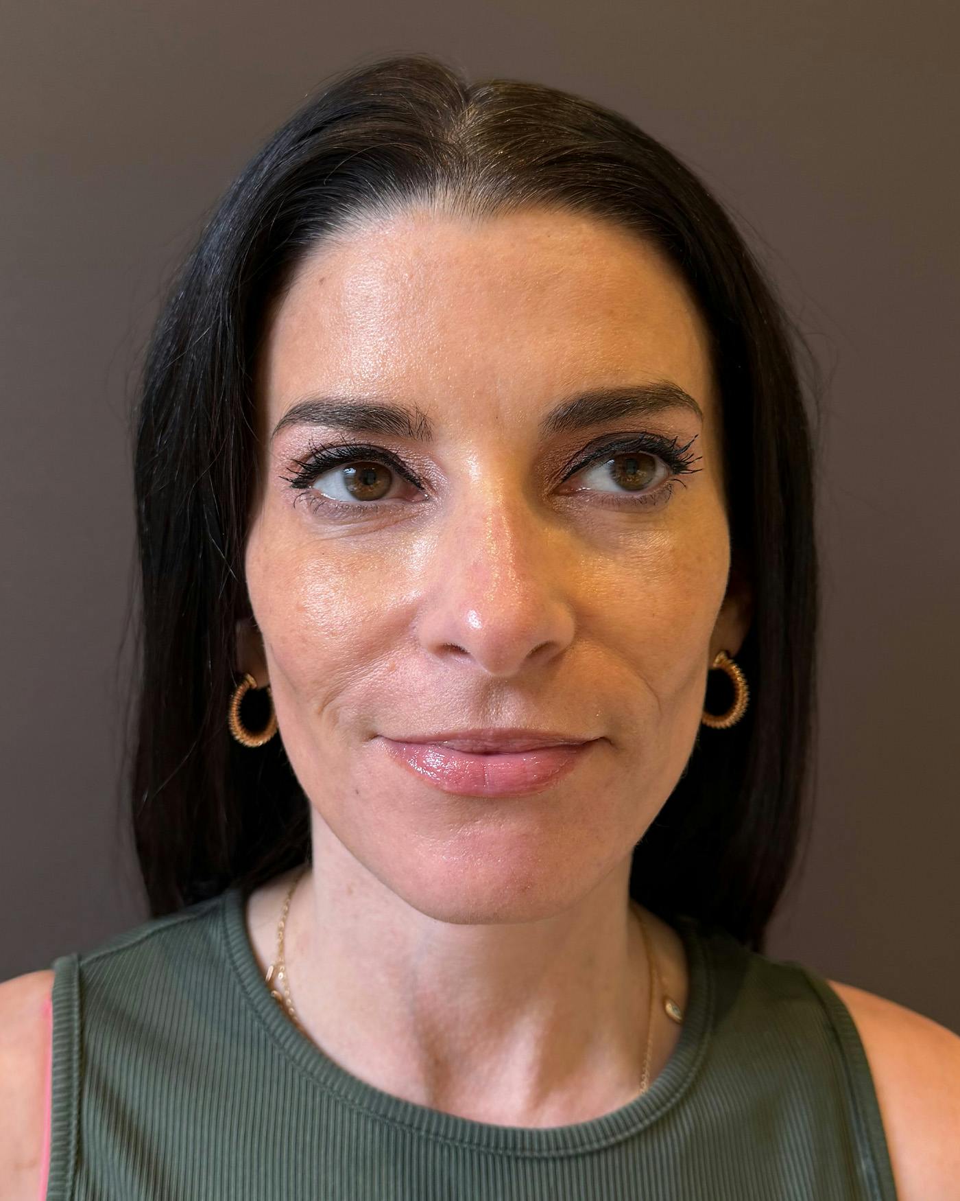 Facelifts / Necklift Before & After Gallery - Patient 371263 - Image 6