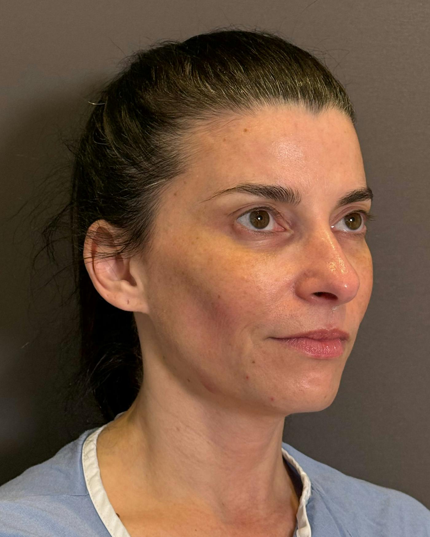 Facelifts / Necklift Before & After Gallery - Patient 371263 - Image 1