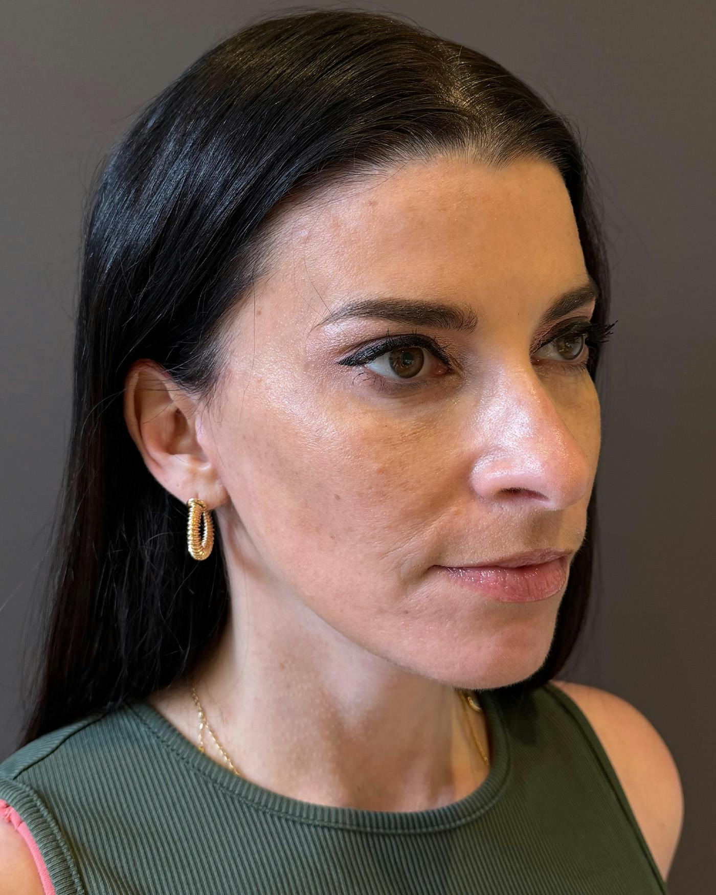 Facelifts / Necklift Before & After Gallery - Patient 371263 - Image 2
