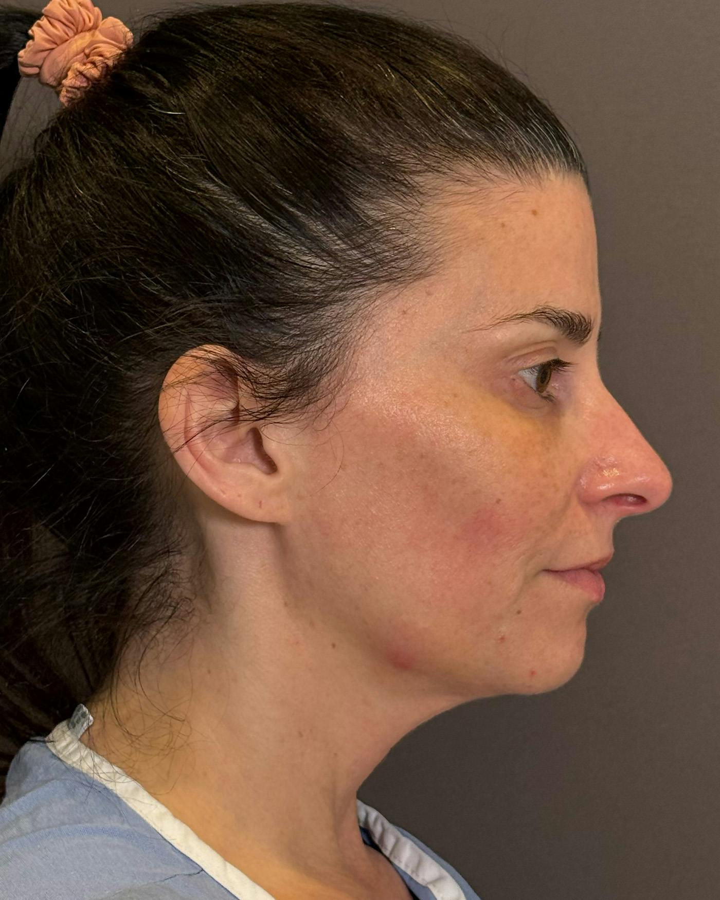 Facelifts / Necklift Before & After Gallery - Patient 371263 - Image 3