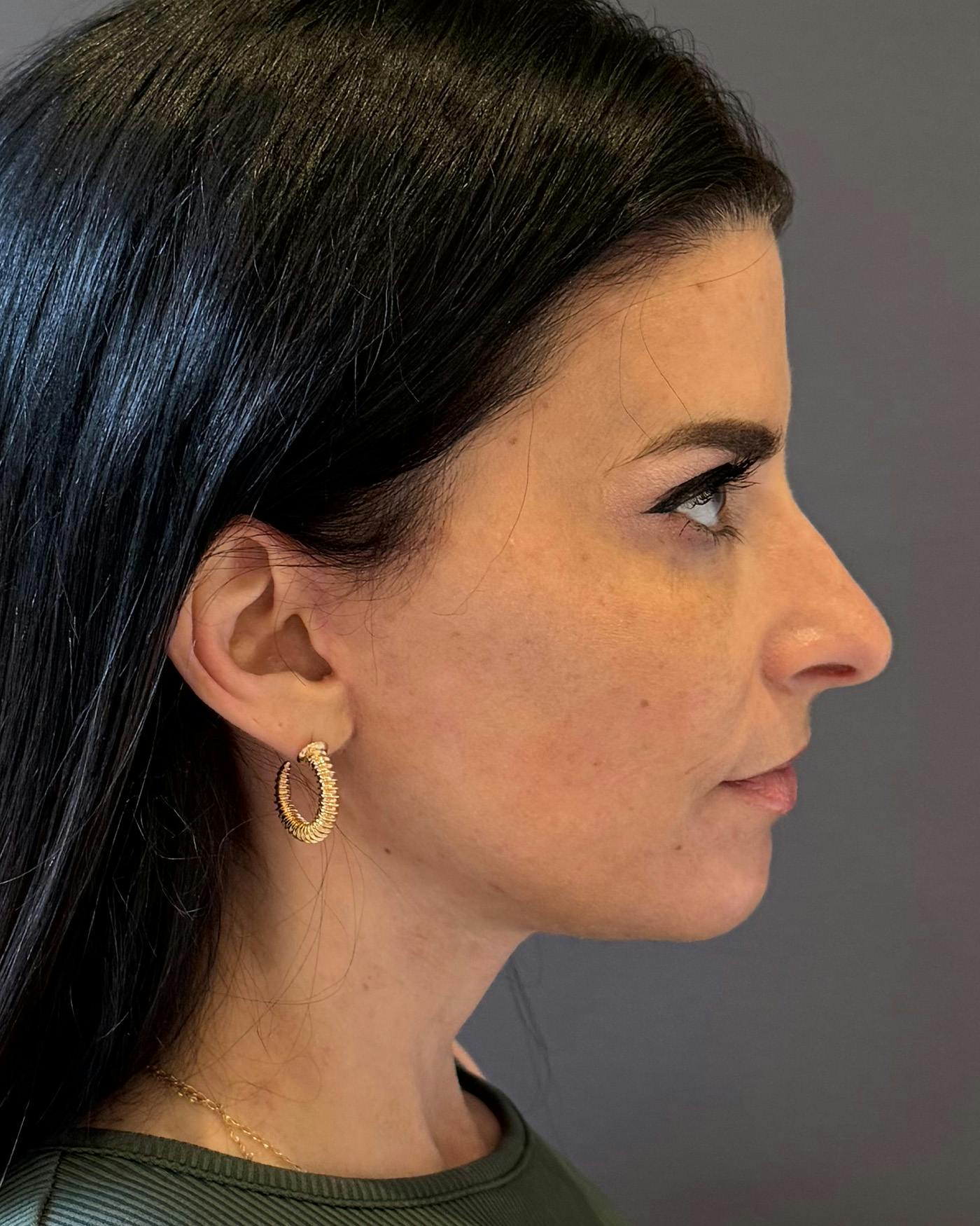 Facelifts / Necklift Before & After Gallery - Patient 371263 - Image 4