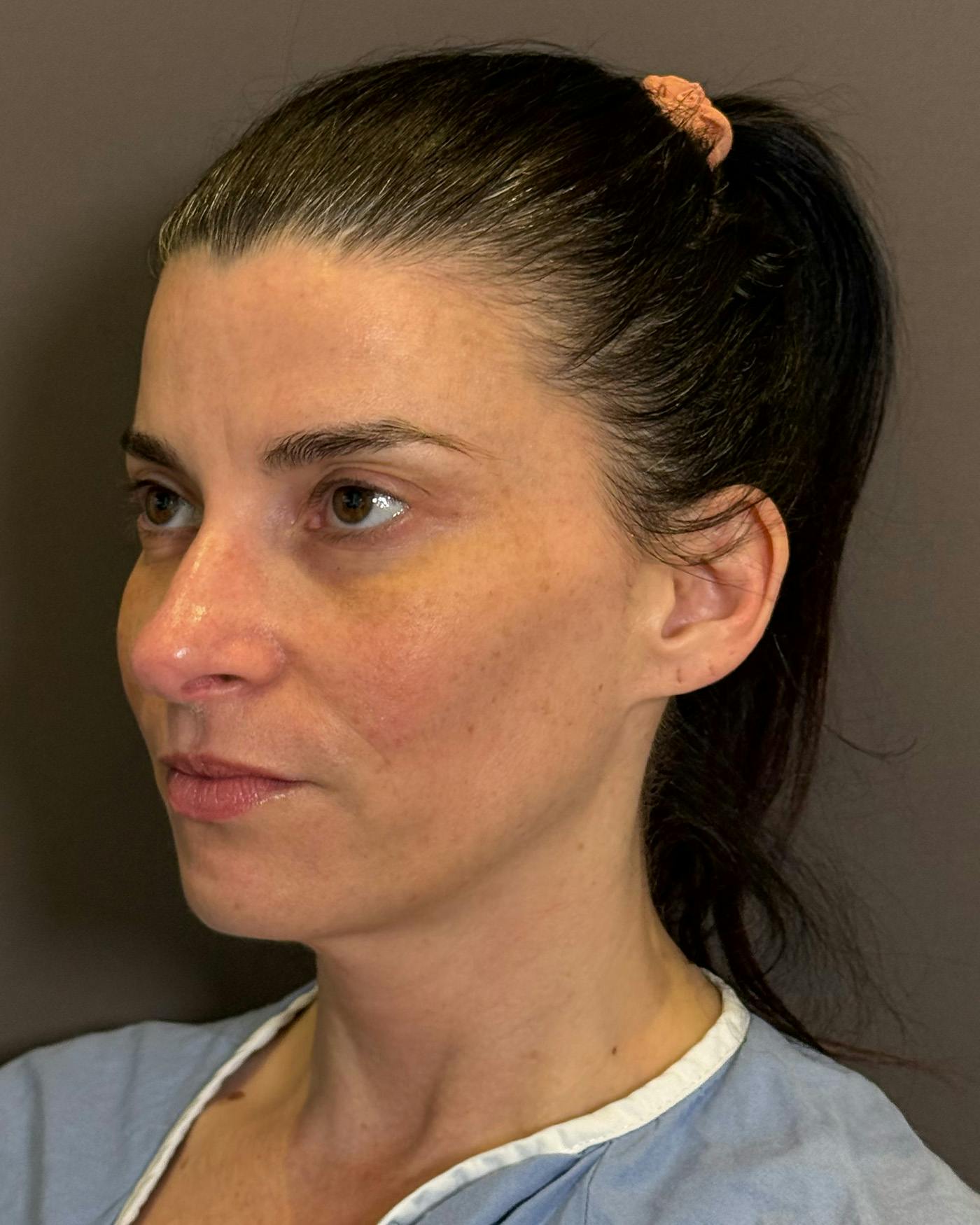 Facelifts / Necklift Before & After Gallery - Patient 371263 - Image 7