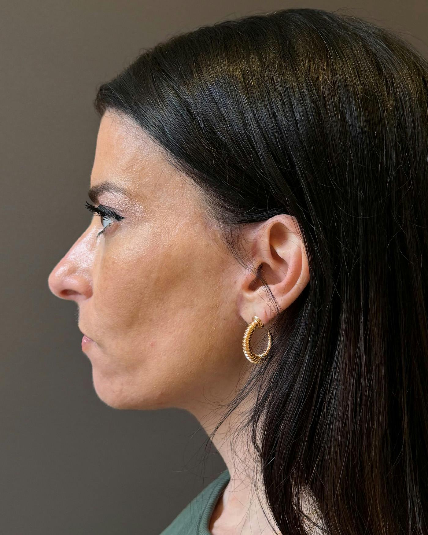 Facelifts / Necklift Before & After Gallery - Patient 371263 - Image 10