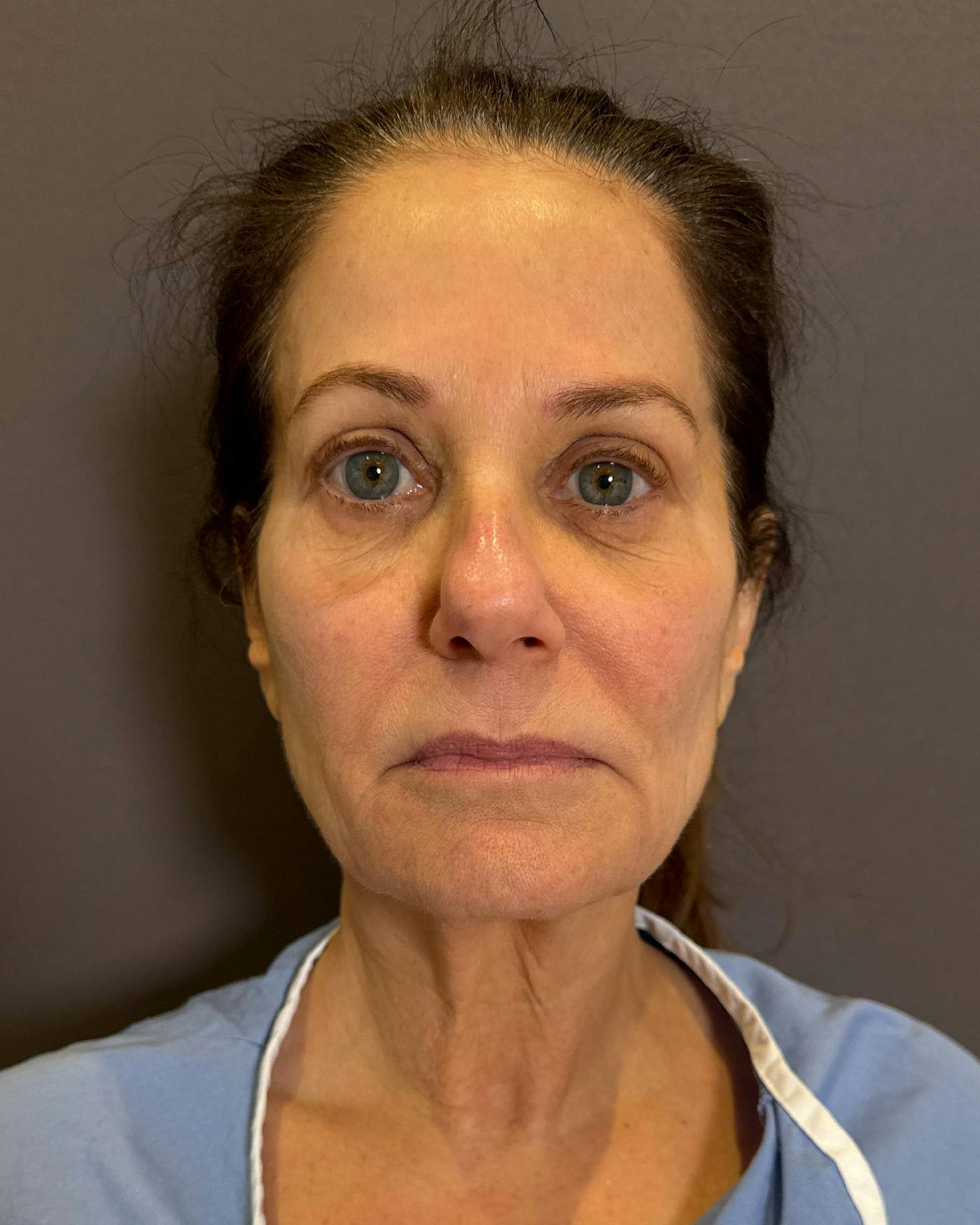 Eyelid Surgery Before & After Gallery - Patient 327634 - Image 3