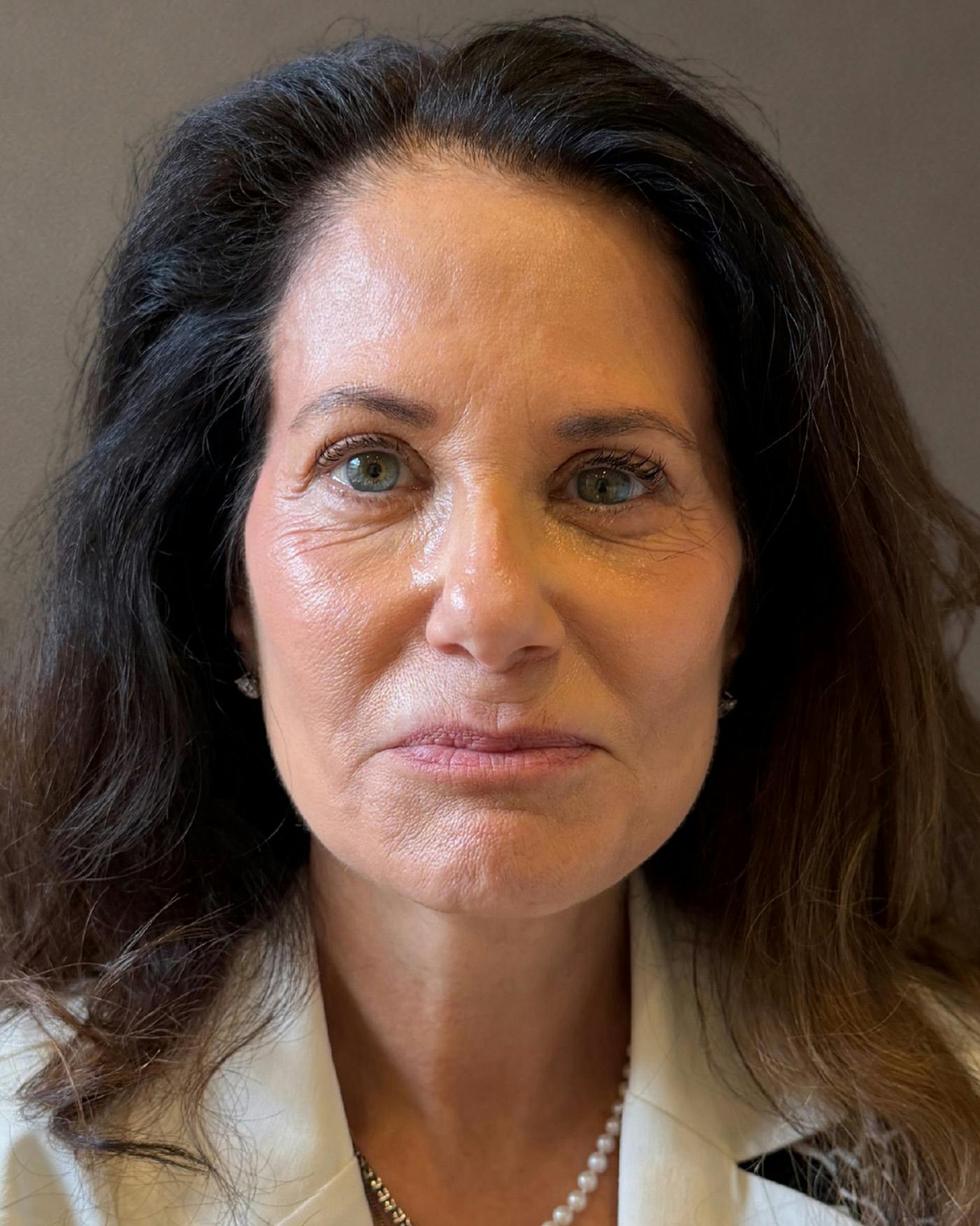 Eyelid Surgery Before & After Gallery - Patient 327634 - Image 4