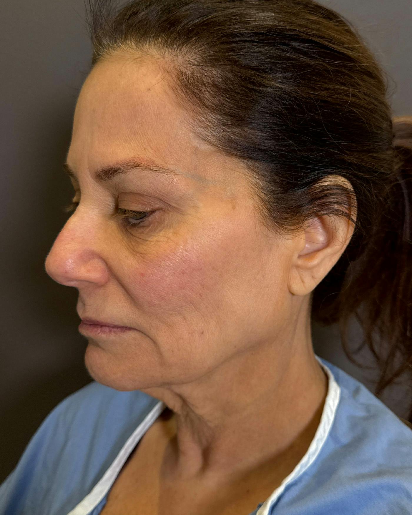 Eyelid Surgery Before & After Gallery - Patient 327634 - Image 5